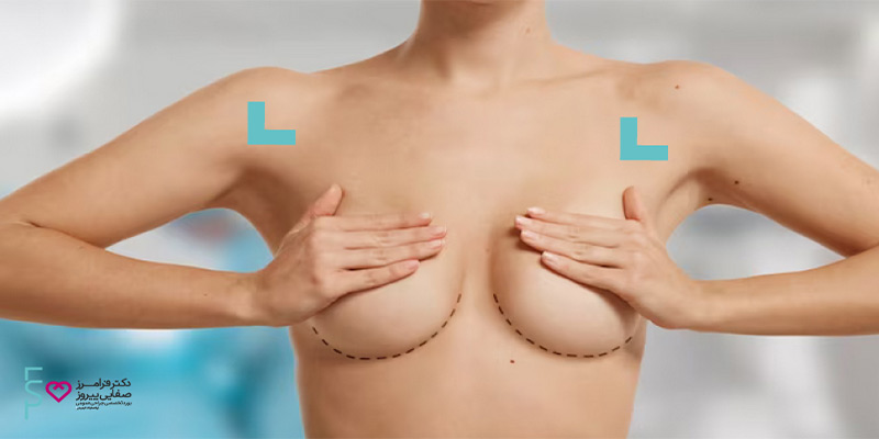ایمپلنت سینه | اسکارهای ناشی از جراحی ایمپلنت پستان